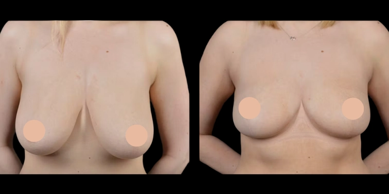 Before and after result of Female breast reduction