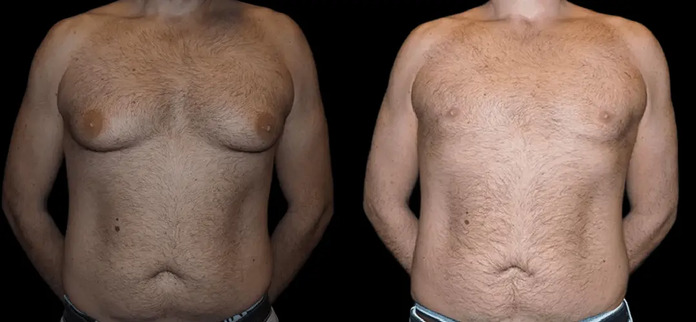 male breast reduction transformations.