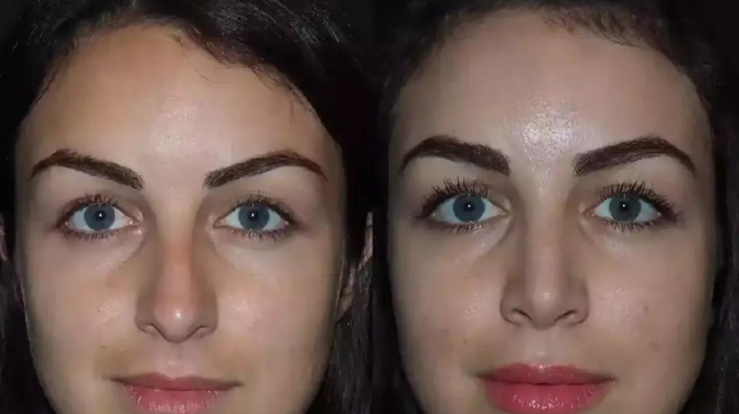 Rhinoplasty and Scars: What to Expect