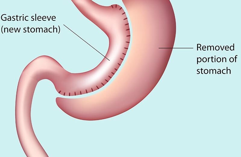 Gastric Sleeve Surgery