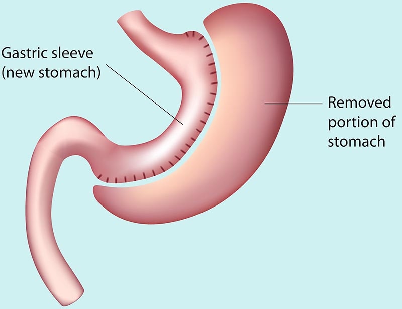 Gastric Sleeve Surgery