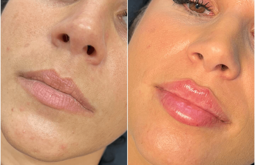 Juvederm Fillers