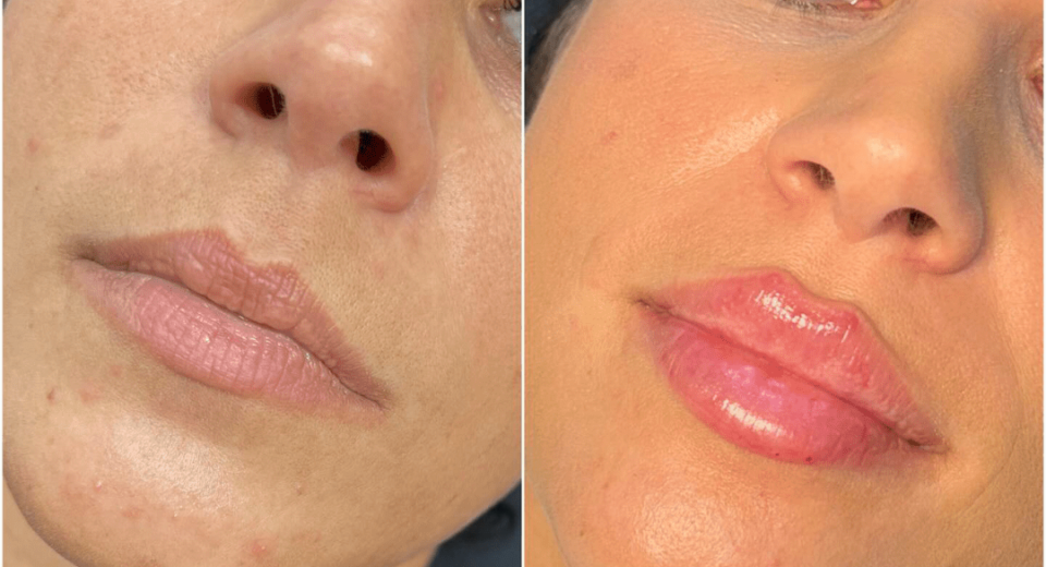 Juvederm Fillers