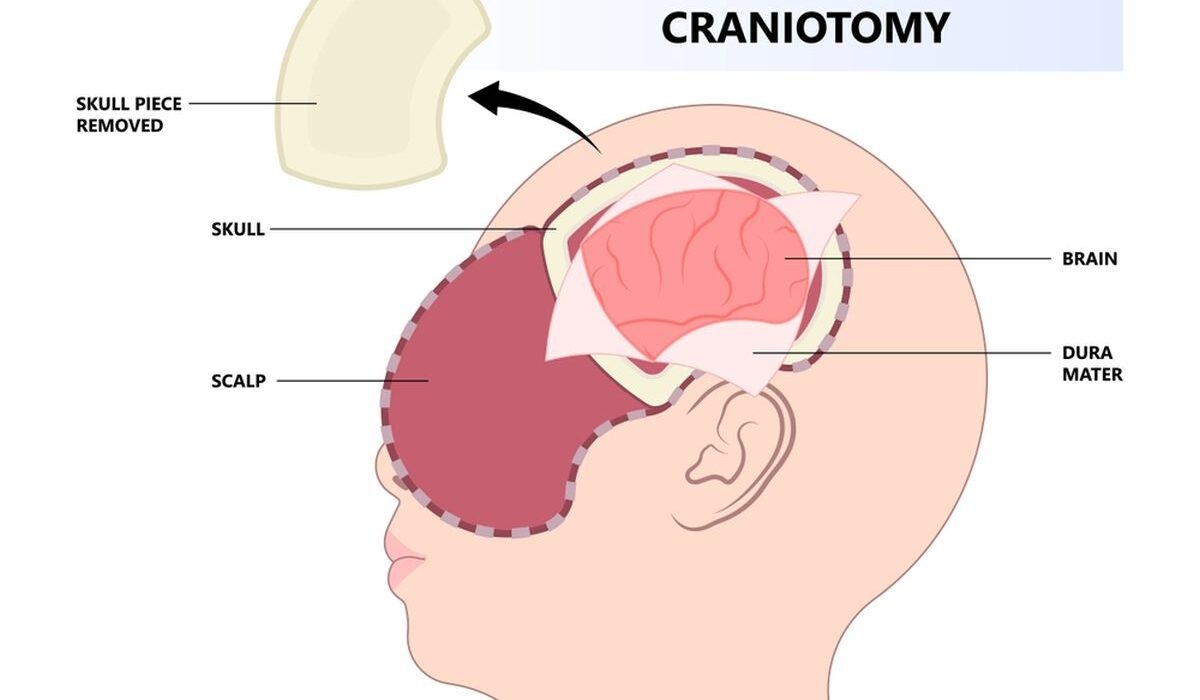 Cranioplasty