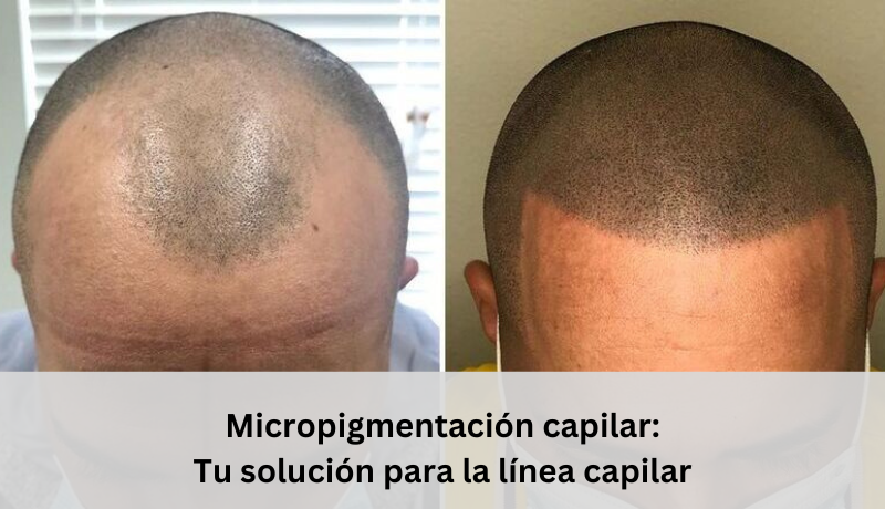 micropigmentacion capilar