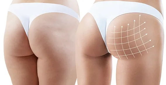 Comparing Services The Best Aesthetics Clinic in Dubai for Butt Fillers